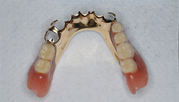 金属床義歯とは