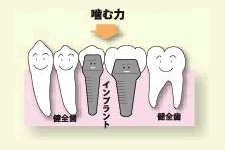 ンプラントは隣の健康な歯を削ることなく植立し、人工歯を取り付けます。自分の歯と区別がつかないくらい治療の跡がわかりません。