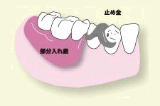 局部床義歯＝部分入れ歯取り外しの入れ歯を作り、バーを左右に渡して固定します。さらに止め金でも固定しますが、口の中のバーや止め金の異物感に加え、口臭の原因にもなります。