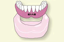 全部床義歯＝総入れ歯全部に床のついた入れ歯を装着します。顎の骨が退縮すると入れ歯が不安定になりやすくなります。