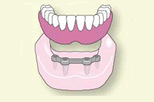 数本のインプラントを植立し、連結された維持装置に入れ歯を固定します。入れ歯が安定し、口の中で動いたり、笑ったときに飛び出したりすることはありません。